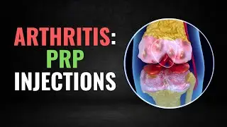 PRP Injections Are Taking Over Knee Arthritis Treatment