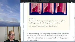 How to reverse atherosclerosis and coronary artery disease and cardiac disease