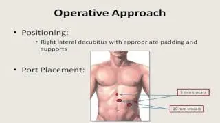 Laparoscopic Subtotal Splenectomy