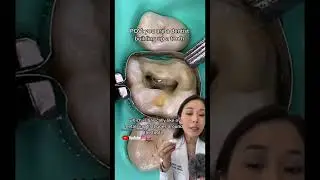 Building a tooth back up after cavity removal. 