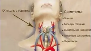 Онкология головы и шеи
