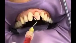 Veneers 2 - Miskin Ajax Dental