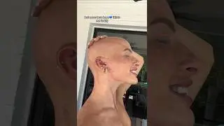 Make that 3 years ago now 🥹 #hairloss #alopecia #atrophy #selflove #alopeciaareatatreatment