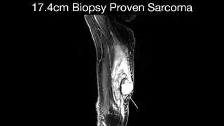 17.4cm Biopsy Proven Sarcoma