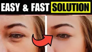 Vanish Under-Eye Bags Fast! Natural Secrets Unveiled