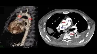Lecture 4  Trunk arteries