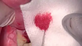 Reconstruction Of A Large Bone Deficiency Using Bond Apatite