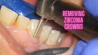 BROKEN ZIRCONIA BRIDGE