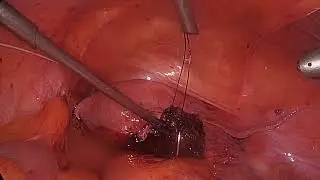 COR 434 092024 Myomectomy