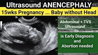ANENCEPHALY - 15 wks Pregnancy Ultrasound | why early Diagnosis is important
