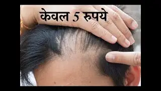 केवल 5 रुपये में गंजे सिर पर बाल उगाने का सबसे कामयाब घरेलू नुस्खा।। गंजेपन से छुटकारा पाए