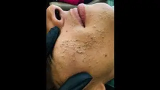 Best Blackhead Extraction Video Removel