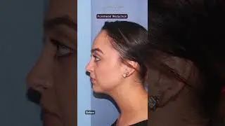 Forehead Reduction — Before & After