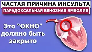 Открытое Овальное Окно | Парадоксальная венозная эмболия