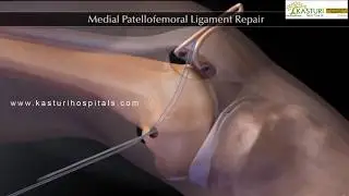 Knee Cap Surgery Hyderabad | Patella Dislocation Treatment | Patellofemoral Ligament Repair