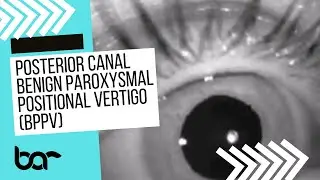 Posterior Canal BPPV Nystagmus