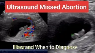 Ultrasound, How to Diagnose Missed Abortion, What is minimal time for Fetal Cardiac Activity ,