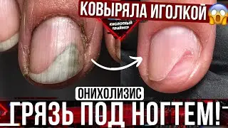 ⚡ДОКОВЫРЯЛАСЬ ИГОЛКОЙ ДО ОНИХОЛИЗИСА!😱 Зачистка онихолизис ногтей на руках🤓