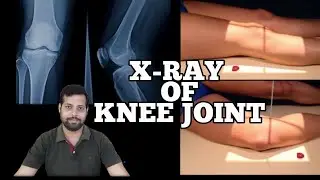 HOW TO DO KNEE JOINT X-RAY. #xrayclasses #anatomy #KNEEJOINTXRAY. घुटने का एक्सरे कैसे करते हैैं?