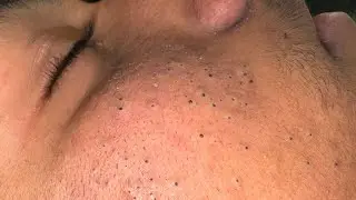 Deep Cleansing Techniques for Acne-Free Skin | Pimple & Blackhead Solutions