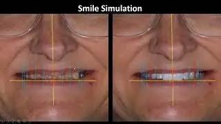 FP1 Immediate Load Maxillary Arch with Stackable Scalloping Guide