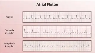 Intro to EKG Interpretation - Overview of Tachyarrhythmias