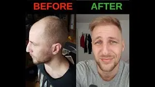Hair Transplant Turkey 9 months in 30 seconds