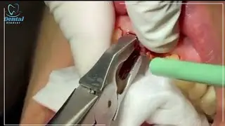 Extraction of upper remaining roots