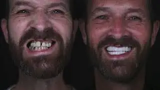 David's Smile Makeover Journey / Dental Implants Turkey