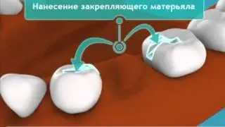Адгезивное протезирование