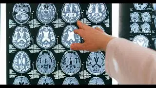 Study of Anatomy and Gender Wise Distribution of Corpus Callosum of Brain