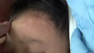 20150430 小邑被叮得滿頭包