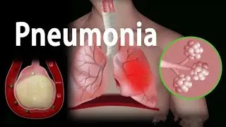 Pnemonea Kaya hota hai || निमोनिया क्यों होता है? कारण और निमोनिया का इलाज!