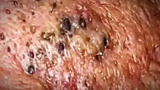 Most Satisfying Blackhead Removal 2024