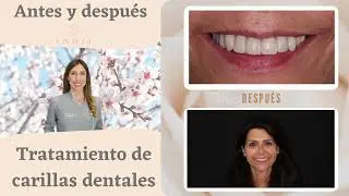 Antes y Después Carillas dentales