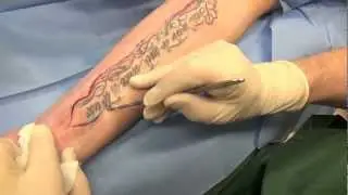 Borttagning av tatuering Tatoo removal Primakliniken