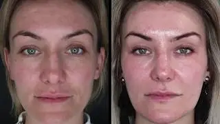 ActiveFX Laser Resurfacing - Siobhan's Testimonial | The Laser and Skin Clinic