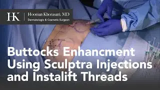 How to perform a Buttocks Lift Using Sculptra and Threads by Dr. Khorasani