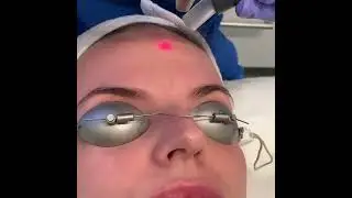 Fotona Laser Peel