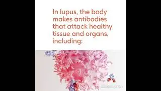 Campaña GSK - Lupus