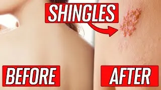 The Stages, Signs & Symptoms of Shingles