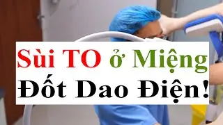 Hướng Dẫn Nhận Biết Sùi Mào Gà Trong Miệng & Thực Hiện Đốt Dao Điện Cho Bệnh Nhân | Bác Sĩ Sắc