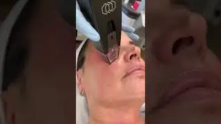 Help Tighten Your Skin & Improve Fine Lines and Wrinkles Before Summer! 