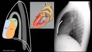 Lateral CXR  Part 1 Anatomy - 