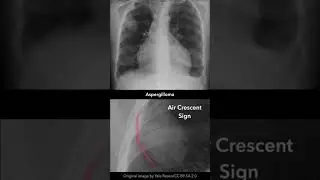 Aspergilloma Chest X-ray 