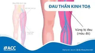 Hiểu đúng về đau thần kinh tọa cùng chuyên gia ACC
