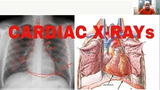 Cardiac x ray lecture: Cardiomegaly, Pericardial effusion, Valvular heart disease, Pace maker, TOF