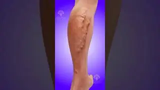 How Varicose Veins Develop 😱 #shorts #viralvideo - creativelearning3d