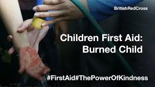 Child First Aid - Helping a child with a burn