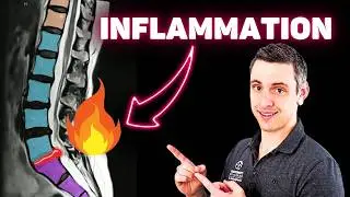 The Real ROOT CAUSE of Chronic Back Pain (pt.5) - Spine Inflammation (Peripheral Sensitization)
